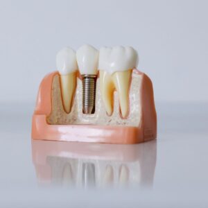 Implant zircone.